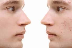 Steam Sauna for Acne Treatment: The Canadian Guide to Clearer Skin with AuraPro Sauna